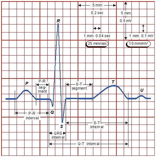 Obr. 5 Geneze elektrokardiogramu svodů I, II a III [4] Obr.