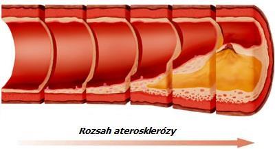 metabolický syndrom ateroskleróza rizikové faktory Hypertenze mechanické poškození endotelu Cholesterol (LDL, dyslipidemie) usazování pod endotelem Diabetes mellitus hyperglykémie, glukoza se lepí na