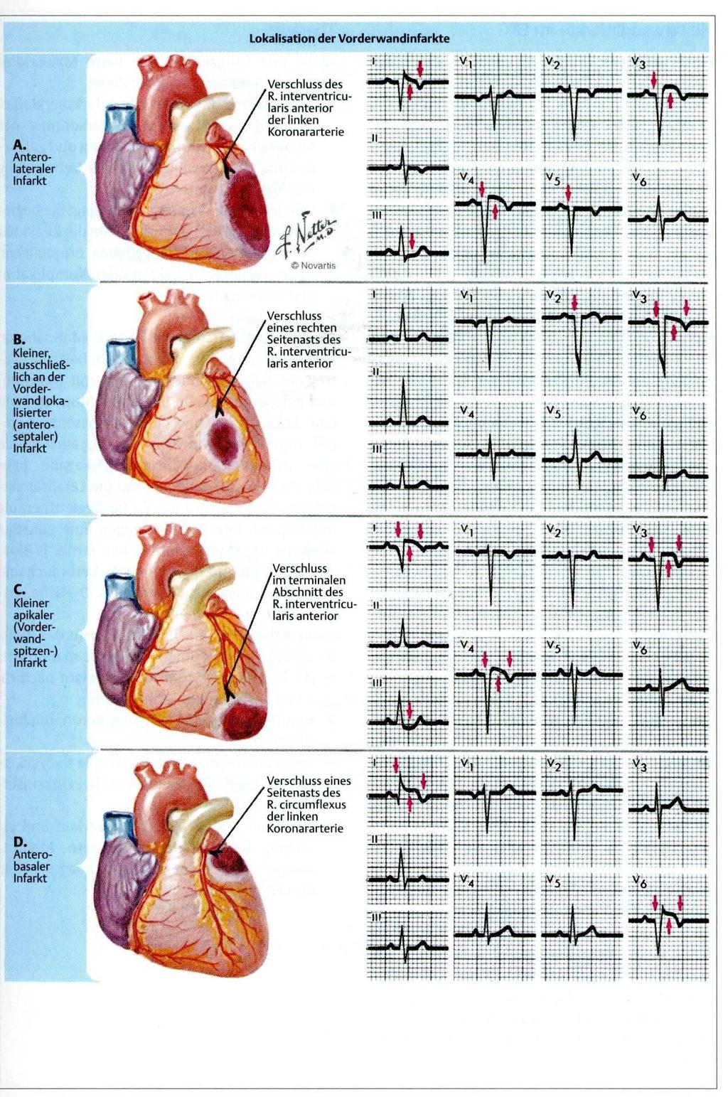 Infarkt