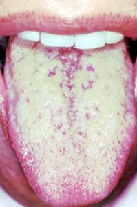 Obrázek 1. Povlak na jazyku zdroj: http://curezone.com/upload/blogs/tongue221.jpg Slina má v dutině ústní ochrannou a antibakteriální funkci.