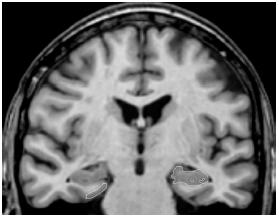 Změny v mediotemporální oblasti u AD (hipokampus, entorinální kůra, amygdala)