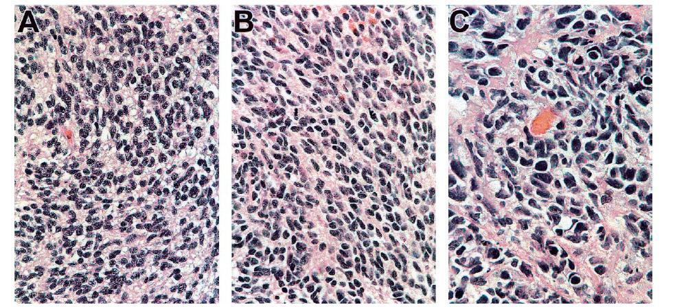 Anaplasie SR MBL: 5y OS 89% versus 75% (P.