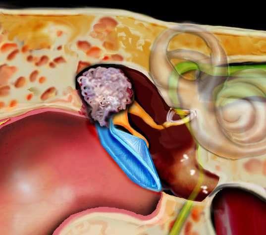 Cholesteatom získaný Pars