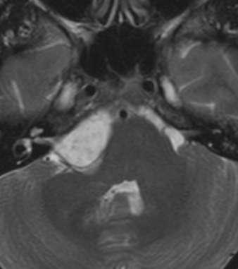 Epidermoidní cysta lokalizace Intradurální 90% mostomozečkový kout 40 50% suprasellární cisterna 10 15% IV.