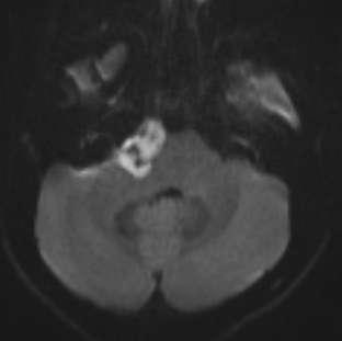 Epidermoidní cysta zobrazení CT nízká denzita (0 HU) - nápadně připomínají arachnoidální cystu - kalcifikace 10