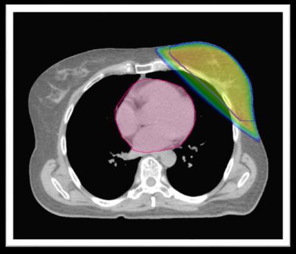 techniku bylo IMAT (Intensity Modulated Arc Therapy).