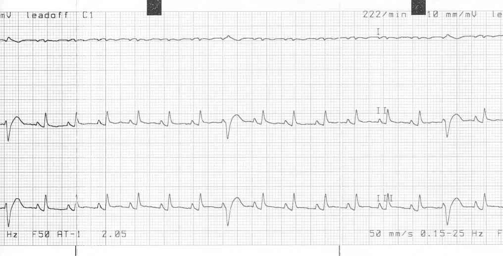 Ferret with DCM - ECG strip