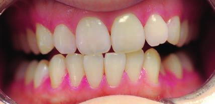 U cervikálního okraje je silný girlandovitý lem temně fialového/modrého, tedy zralého zubního plaku.