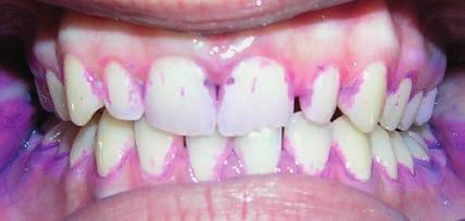 Pacientka uvádí krvácení při čištění a stěžuje si na bolest dásní. 1 týden Pacientka na 2. návštěvě ukazuje velký pokrok v ústní hygieně.