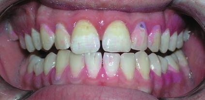 Orálně jsou korunky zubů pokryty plakem z více než 2/3. Pouhou aspekcí detekce caries dentium 22 vestibulárně, 16 distálně, rotace 45. Gingivitis chronica, gingiva edematozní, okraje navalité.