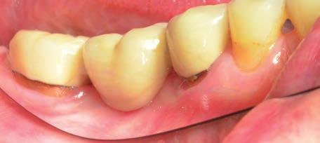 plaku vidíme z lingvální strany na obnaženém kořeni zubu 37. Plak index 1,5 Použitá náplň do PSAU: po celou dobu pouze čistá voda.