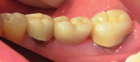 detekovali neúplné odstranění zubního plaku na vestibulární straně sledované oblasti. RVG pacientky: vidíme endodonticky ošetřené pilířové zuby 35 a 37.