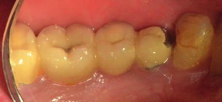 Vhodné by bylo i rozšíření připojené gingivy u pilířového zubu 44 a prohloubení vestibula v krajině mezičlenu 45 a 46 s odstraněním tahu vestibulárních slizničních řas.