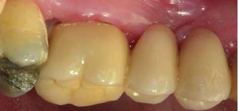 nánosy plaku hlavně v oblasti mezi zuby 26 a 27, dále vidíme zduření gingivy výrazné hlavně z vestibulárního pohledu v oblasti mezičlenu 24 a 25, které je provázeno i spontánním krvácením.