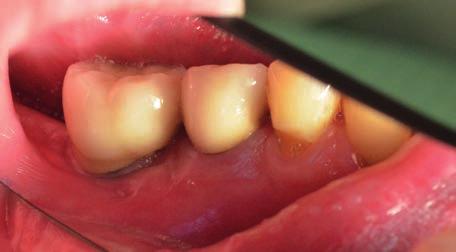 Věk: 63 Pohlaví: muž Typ ošetření pacienta: kovokeramický můstek s pilířovým zubem 35 a implantátem v krajině 36 (zhotovení můstku 15. 3. 2006).