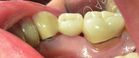 Na vestibulární straně pozorujeme menší množství zubního plaku ve srovnání s lingvální stranou, protože zde nejsou obnažené kořeny zubů a zuby jsou kryty keramikou, která vykazuje menší retenci plaku.
