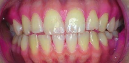 V dolním zubním oblouku se po obarvení objevují okrsky nafialovělého zralého plaku. Komprese v dolním zubní oblouku, proto doporučena konzultace na ortodoncii.