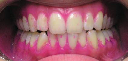 Mezizubní kartáčky pacientka používá pravidelně, přesto je u pacientky retence zubního plaku především interdentálně. QHI: 0,66 5 měsíců U S.P. došlo k výraznému zlepšení ústní hygieny.