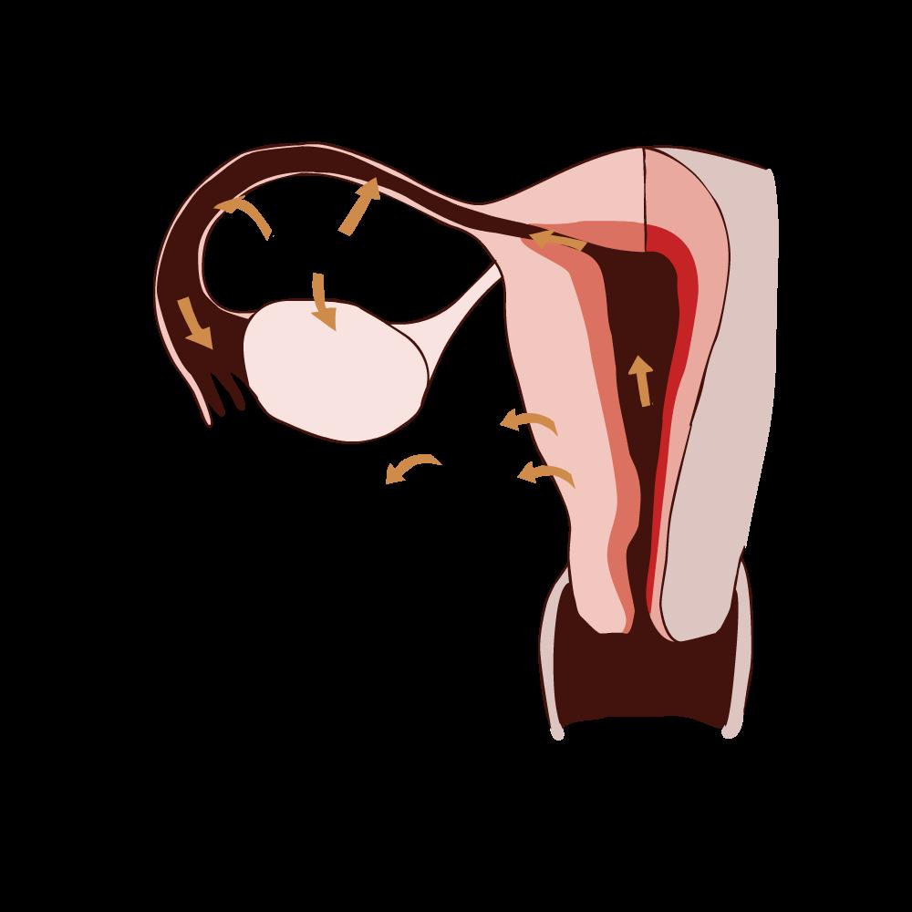 anaemia secundaria prolongata carcinoma ovarii lateris