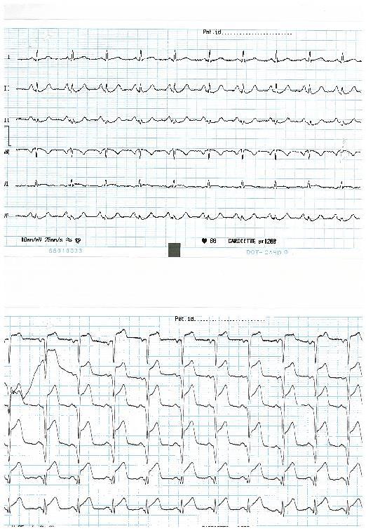 EKG