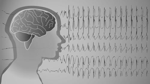 Neuromonitorace + hladina THP ICP CPP udržovat < 25 mmhg, preferenčně < 20 mm Hg udržovat > 60-70 mmhg EEG monitorace kontinuálně cílový vzorec burst