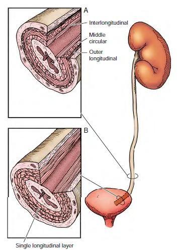 Patofyziologie POM Tradiční anatomický pohled: afunkční segment UVJ - ganglia intramurálně přítomna (nejde o M Hsch) - v intramurálním průběhu převaha