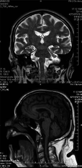 Demence s Lewyho tělísky s klinickým obrazem sporadické  Creutzfeldtovy-Jakobovy choroby - PDF Free Download