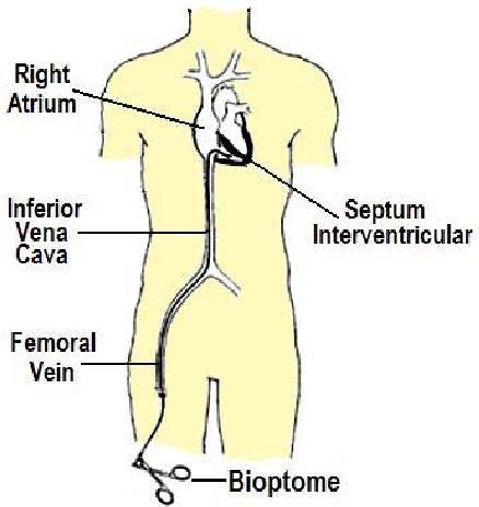 Obr.1 Vedení sondy Obr.2 Bioptom https://www.sjm.com/en/professionals/resources-andreimbursement/technicalresources/vascular/endomyocardial-biopsyforceps/biopsy-forceps, cit. 7.4.