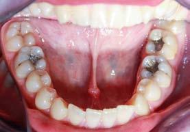 V tomto případě, v němž se jednalo o zub s dobrým biologickým faktorem, jsme zvolili po dohodě s pacientem první variantu s vědomím, že její úspěšnost