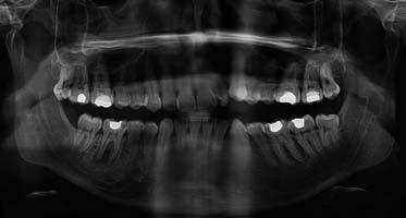 V první fázi endodontického ošetření jsme odstranili amalgámovou výplň a sanovali kaz meziálně.