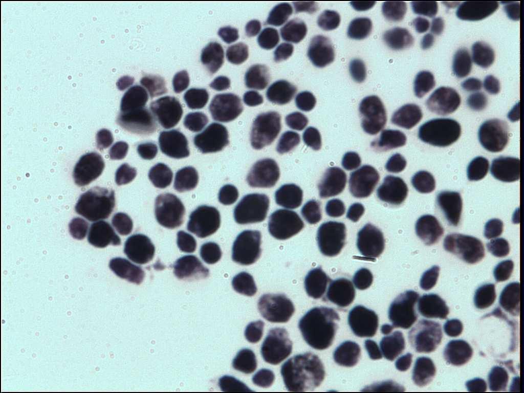 Ostatní kandidy Candida tropicalis izolovaná ze čtvrtiny invazivních kandidóz (C. albicans z poloviny) po C.