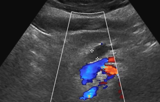 CHP - ultrasonografie slinivka atrofická, kalcifikovaná či fibrotická, u autoim.