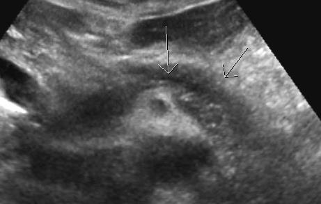 fibrotizující proces) pseudocysty (21%) fokální hyperechogenity (40%, často