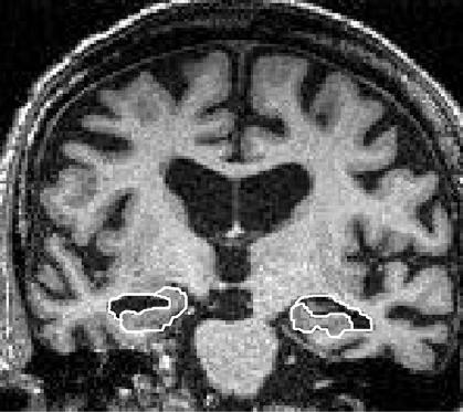 Hipokampální atrofie na MR mozku