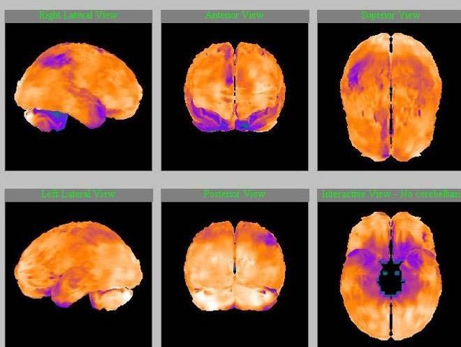 SPECT mozku Alzheimerova nemoc mírná kognitivní porucha nové