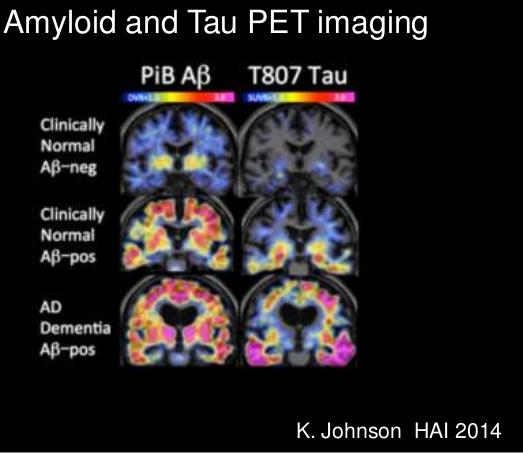 Zobrazení histopatologických ložisek za živa amyloidní PET mozku (tau PET) Amyloidní PET mozku dostupný v ČR: 1) neurolog 2) kognitivní centra při Neurologických klinikách 3) splnění indikací pro