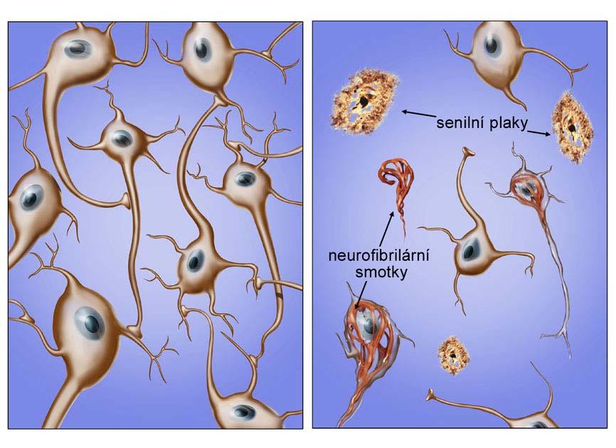 Změny mozku u Alzheimerovy nemoci normální mozek Alzheimerova