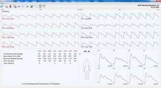 oscilografie komplexní diagnostika funkce žil (test žilních chlopní a svalové pumpy,