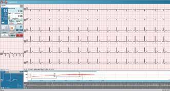 Díky jedno duchosti a přesnosti v detailech poskytuje počítačové EKG Medset ECG-Top svému uživateli během záznamu a analýzy maximální přehled o EKG vyšetření.