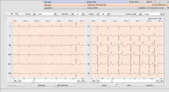 2 ergometrie custo stress EKG variabilní ergometrický systém pro nejširší použití 12-kanálové zátěžové custo stress EKG může