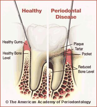Parodontitida Až 80 % dospělých Zánět dásní, narušení spojení mezi zubem a dásní Na místě dásňových sulků vzniká dásňový