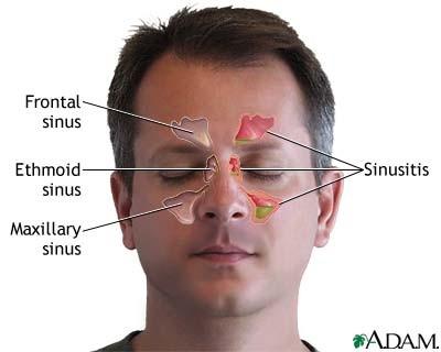 Sinusitis acuta http://www.drgreene.org/body.