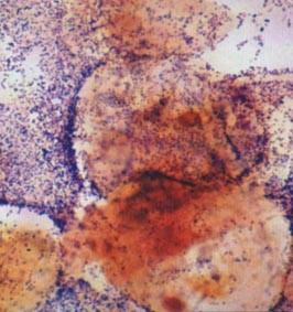 Obraz bakteriální vaginózy (laktobacily nahrazeny gardnerelami, popř.
