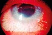 Ohrožení zraku Záření svařovacího