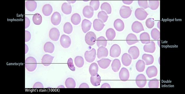 Plasmodium falciparum prstýnky (trofozoity) a gametocyt Obrázek převzat z CD-ROM