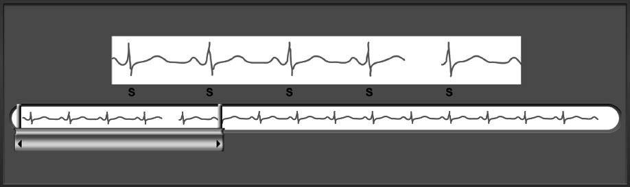 Funkce S-EKG Programátor umožňuje zobrazit, upravit a zaznamenat S-EKG přicházející s přístroje SQ-RX.
