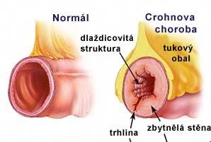 26 CROHNOVA CHOROBA IBD (Inflammatory Bowel Disease) nespecifické zánětlivé onemocnění GITu neinfekčního původu, dosud ne zcela vyjasněné etiologie a patogeneze (faktory významné pro vznik IBD: