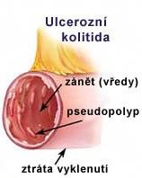 29 ULCERÓZNÍ KOLITIDA idiopatická proktokolitida nespecifické zánětlivé onemocnění tlustého střeva (typicky rektum) postihuje pouze střevní sliznici nález rozsáhlých ulcerací, sliznice je překrvená a