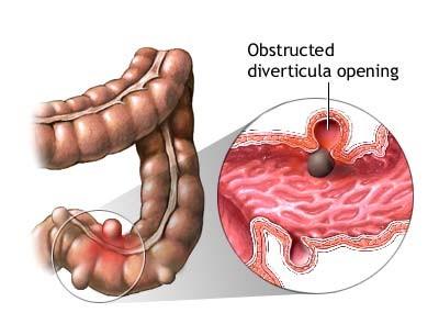 55 DIVERTIKULITIDA onemocnění střeva, při kterém dochází k zanícení střevních výchlipek divertiklů nemoc hromadného výskytu (související se zácpu) Divertikly vznikají působením zvýšeného