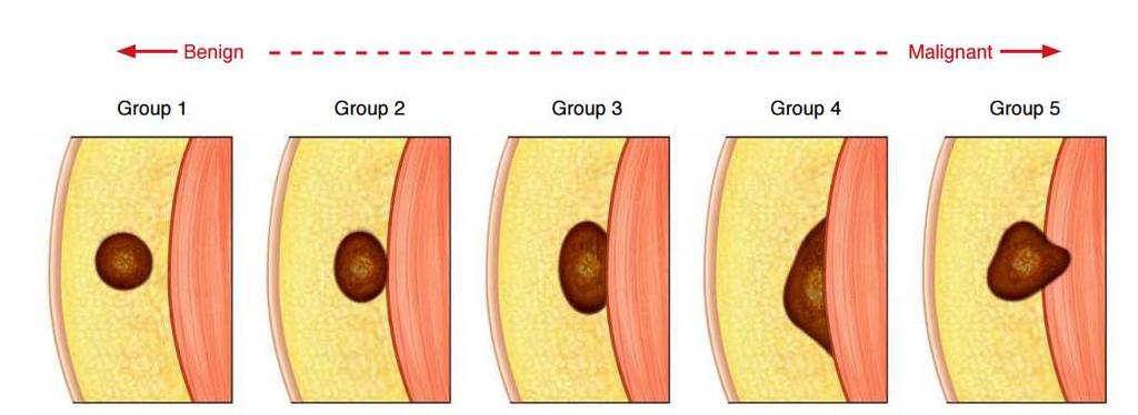 Benigní Povrchověji uložené Menší velikosti Ohraničené Homogenní Hypovaskulární ( mimo hemangiom) Maligní Uložené hlouběji Větší velikosti Nehomogenní krvácení,
